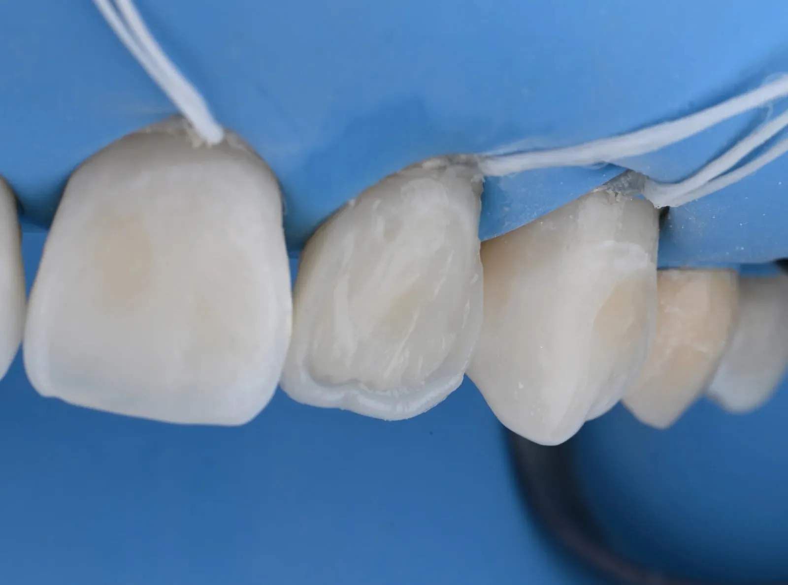 Dents antérieures isolées sous digue pendant une stratification en composite