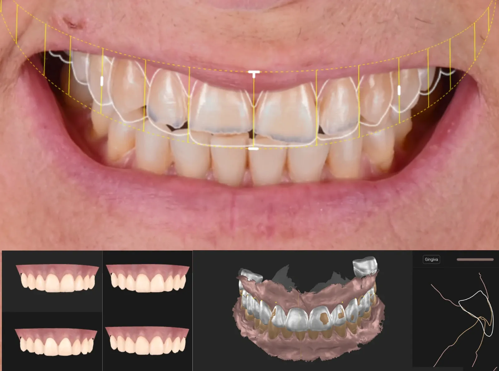 Analyse d’un sourire dans Smilecloud : tracés sur la photographie, projets de formes dentaires et empreinte numérique