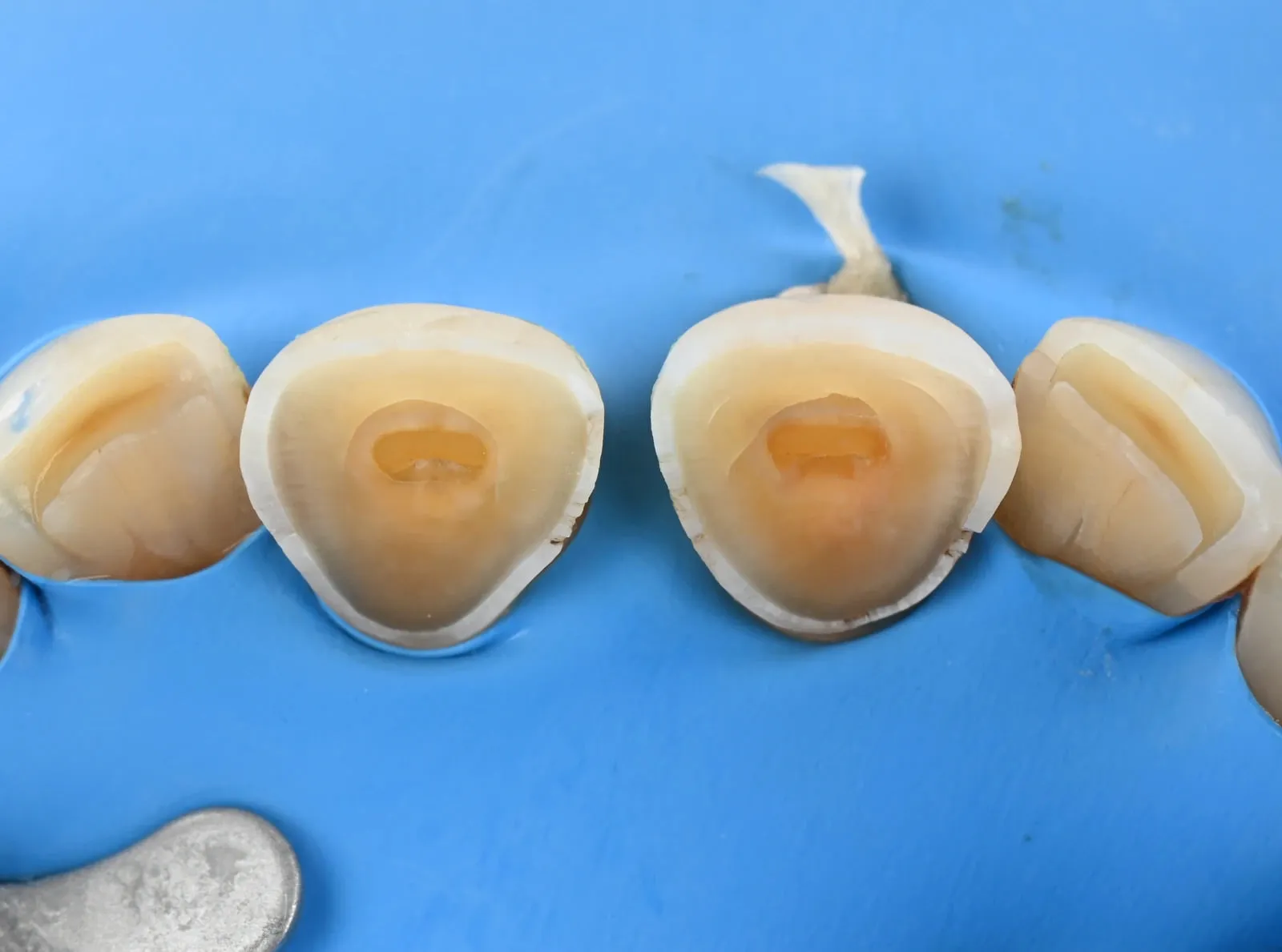 Vue palatine de dents antérieures usées, isolées sous digue